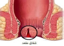 شقاق مقعدی چیست؟